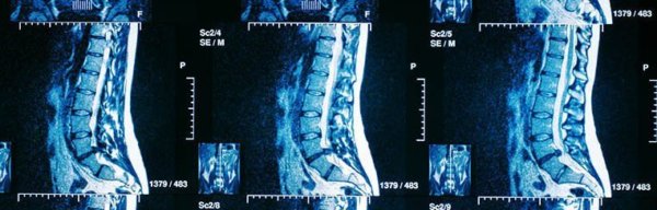 spinal chord injury lawyer